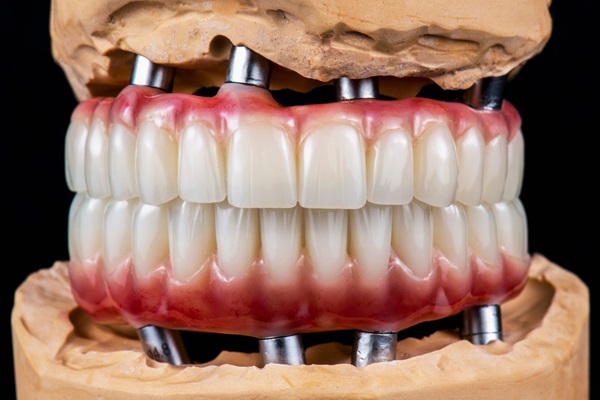 What Are Full Arch Dentures?